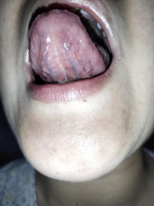 舌头条状肉芽图片对比